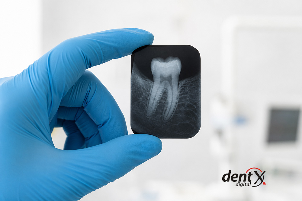 Intraoralni radiogram - pojedinačni digitalni snimak zuba